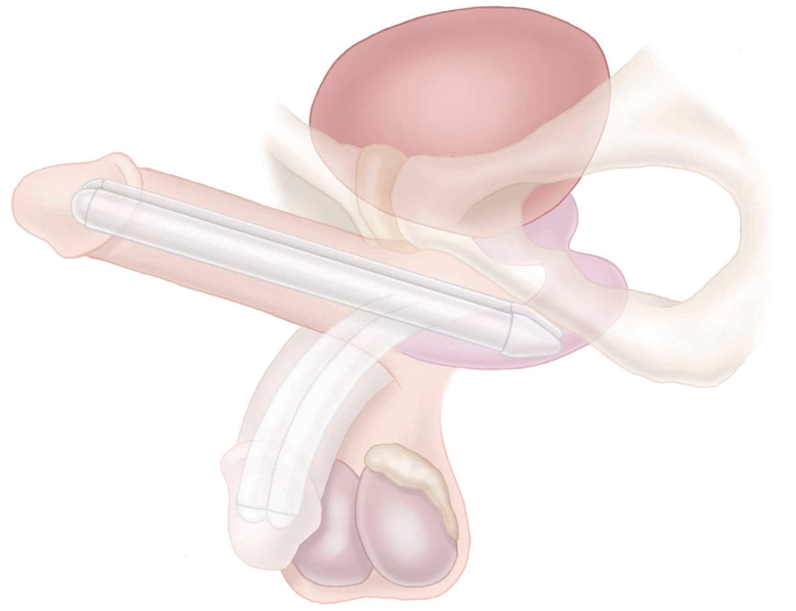 Erectile Dysfunction