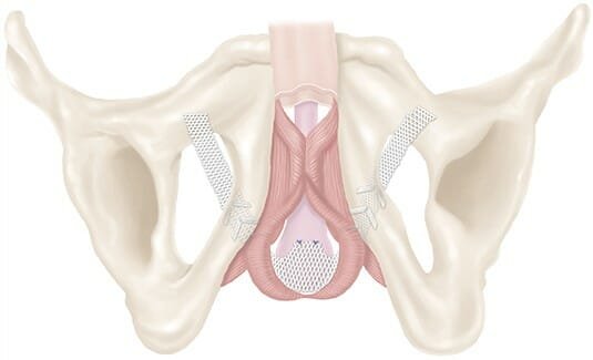 Male Stress Urinary Incontinence
