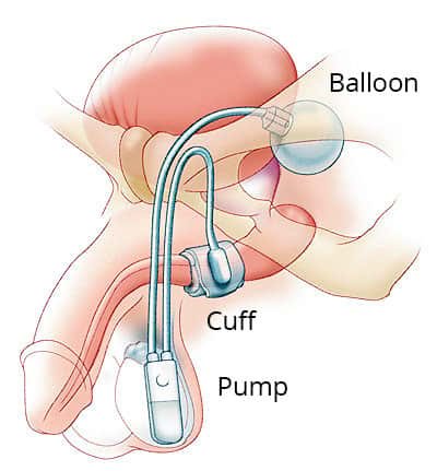 Male Stress Urinary Incontinence